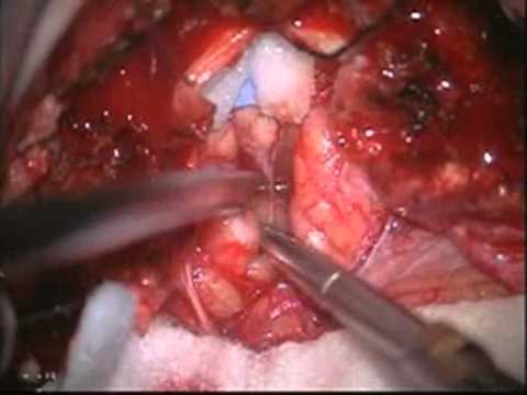 Chiari type I decompression