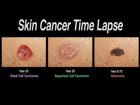 Skin Cancer Time Lapse (Basal Cell Carcinoma, Squamous Cell Carcinoma, Melanoma)