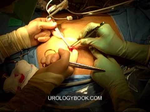Accès initial dans la chirurgie à incision unique