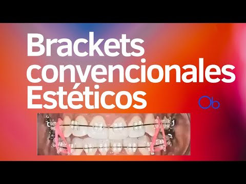 Brackets Convencionales Estéticos