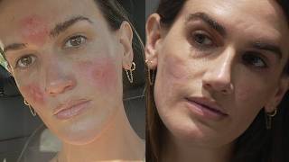 Woman Says She Suffered Severe Burns After Facial From Celebrity Esthetician