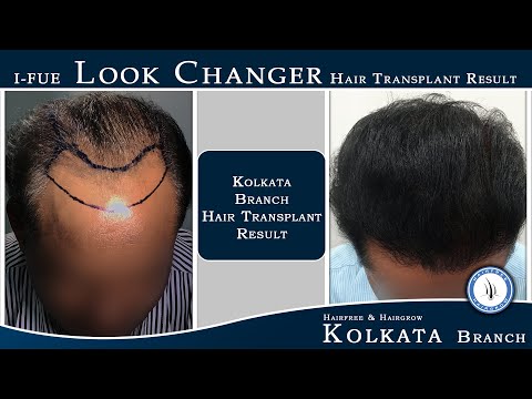 I-FUE Look Changer Hair Transplant Result || HFHG Kolkata Branch Hair Transplant Result and Review