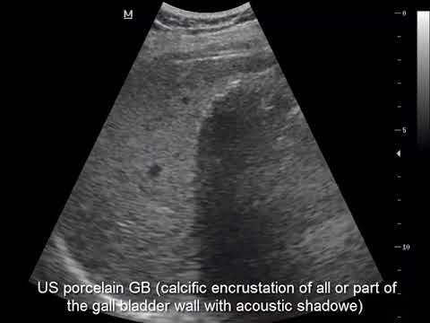 Porcelain Gallbladder - USG