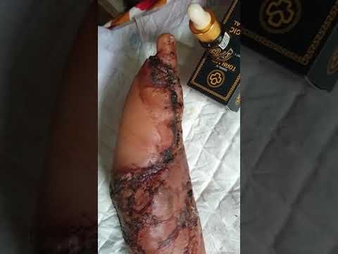 Hoại Tử Do Tiểu Đường, nằm lâu ngày