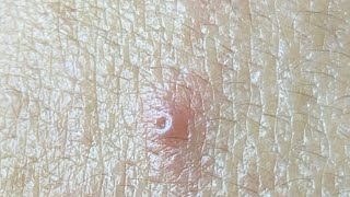 Don’t Ignore Hidden Acne for Too Long #632 P3