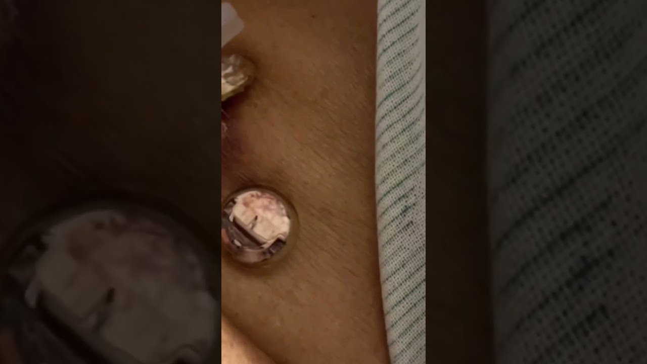 Watch video Gastrostomy Tube Suture remover T fasteners Now Gastrostomy Tube Suture remover T fasteners