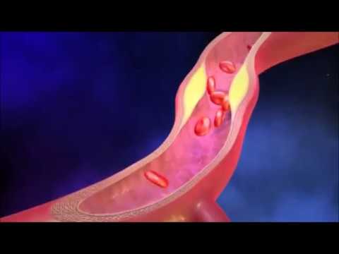 Arteriosclerosis and peripheral arterial occlusive disease