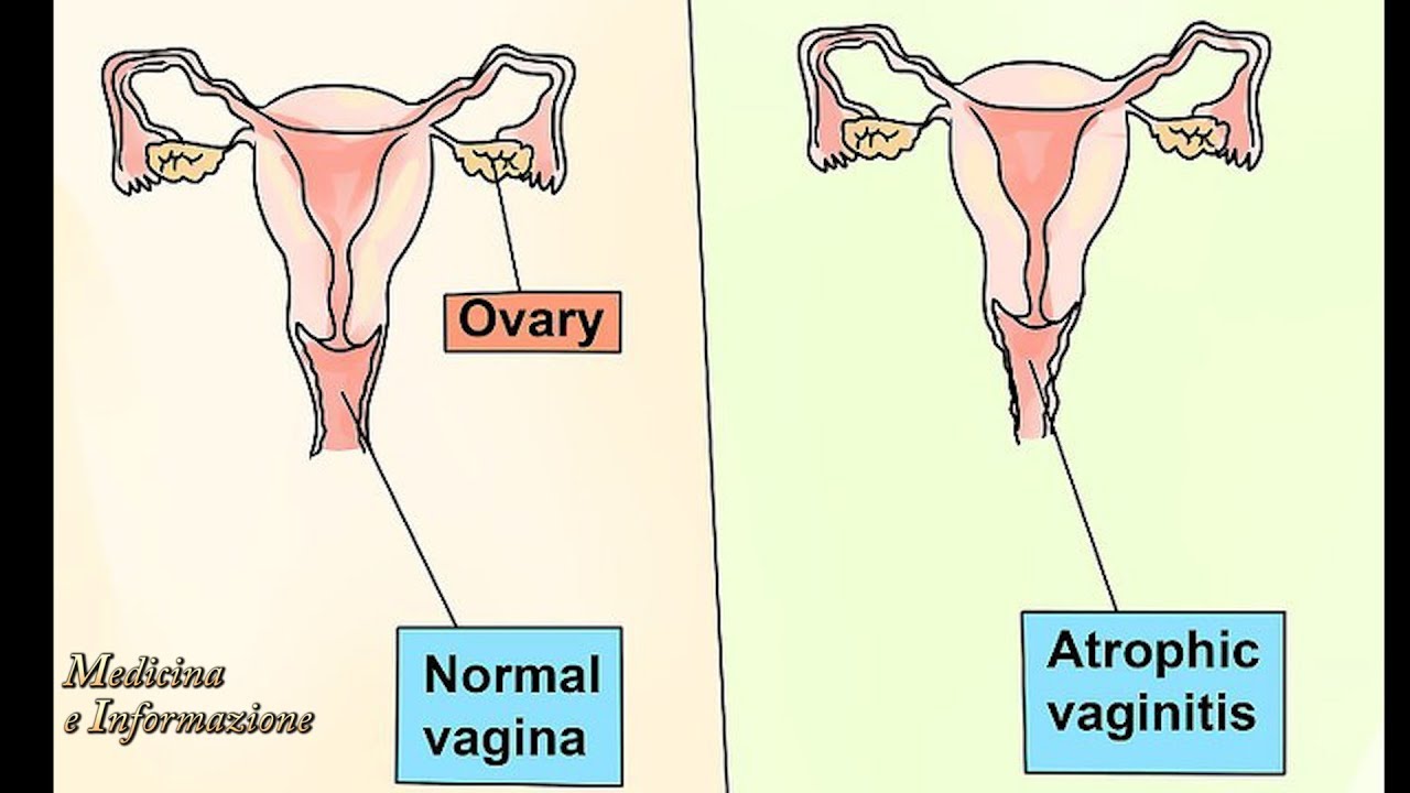 Sindrome Genito Urinaria in Menopausa (atrofia vaginale, dolore ai rapporti, incontinenza, cistiti)