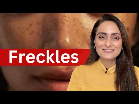 Freckles | causes | treatment | recommendations | Dermatologist