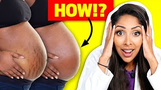 I Tested Stretch Mark Creams So You Don't Have To: Doctor V Reveals All! #stretchmarks