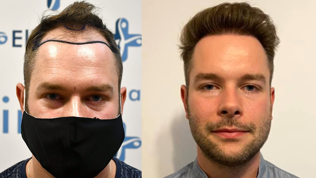 Watch Trasplante capilar antes y después - Recorrido desde el día 1 a los 9 meses #5 Now Trasplante capilar antes y después - Recorrido desde el día 1 a los 9 meses #5