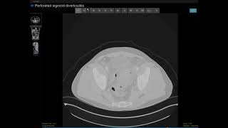 Perforated sigmoid diverticulitis