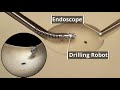 Bone Cyst Surgery Robot with Bendable Drilling and RemoteContro - Hamlyn Symposium on Medical Robotics Bone Cyst Surgery Robot with Bendable Drilling and RemoteContro