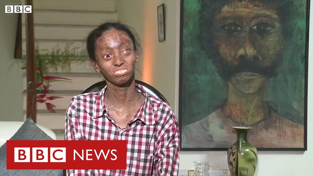 'Minha pele é muito justa para meu corpo': a vida de uma jovem indiana com doença rara