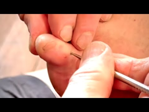 Extremely Deep Little Toe and Foot Reflexology Massage Using Acupressure Pen on Dan Pt1. Gympie AU.