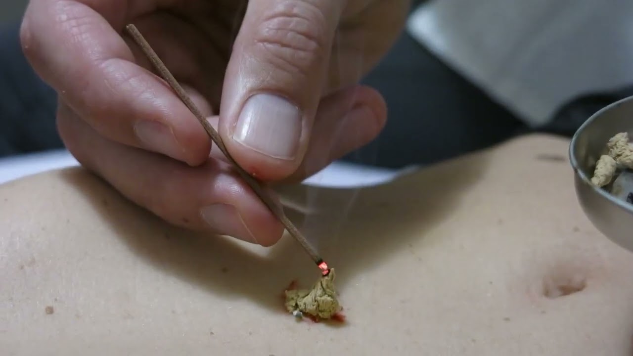 Treatments using Moxa Wool