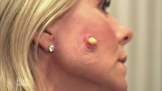 Live's Halloween Countdown: Dr. Pimple Popper video
