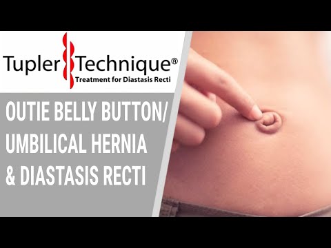 Outie Belly Button/umbilical hernia and Diastasis Recti- Julie Tupler, RN