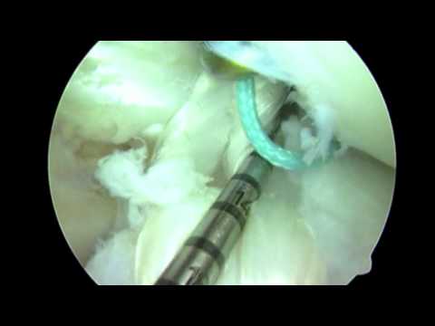 ACL Reconstruction Surgery