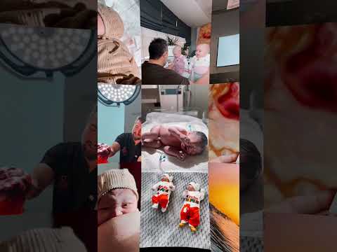 In-Depth Guide to the IVF Procedure in Nicosia, Cyprus: A Journey from Embryo to Twin Delivery