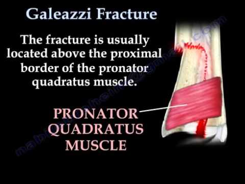 Galeazzi Fracture
