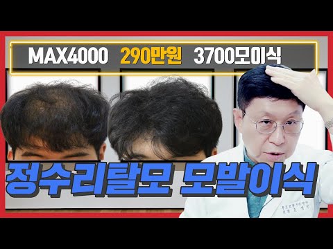 정수리탈모 증모 MAX4000 모발이식비용 290만원  3700모이식 전 후를 소개합니다.