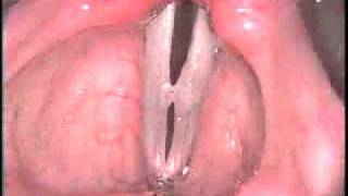 Vocal cord polyps at various pitches