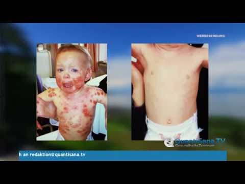 Pepidol bei der Schuppenflechte Die Merkmale der Schuppenflechte bei den Kindern