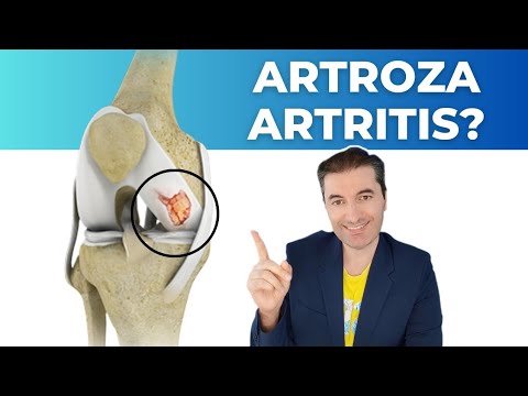 Artritis ili artroza: koja je razlika?
