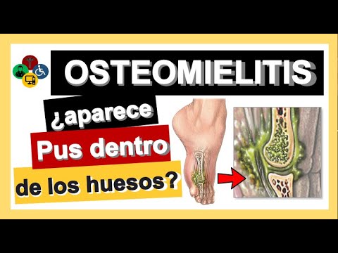 Osteomyelitis: What is it? Symptoms? Treatment