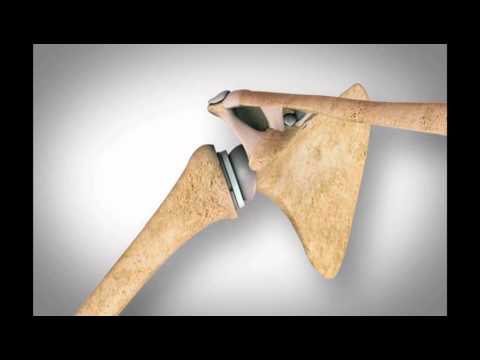 Corsetti osteocondrosi cervicale Malattia genetica dei muscoli e delle articolazioni