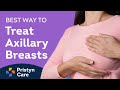 What Are Axillary Breasts How To Treat Axillary Breasts