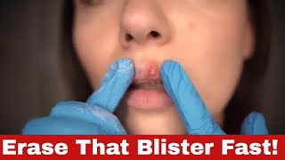 Fast and Effective: How to Get Rid of a Fever Blister in 24 Hours!