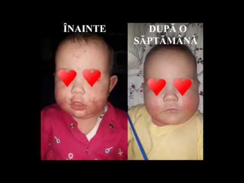 Cum poţi scăpa de viermii intestinali. - Cum să elimini viermii la un copil