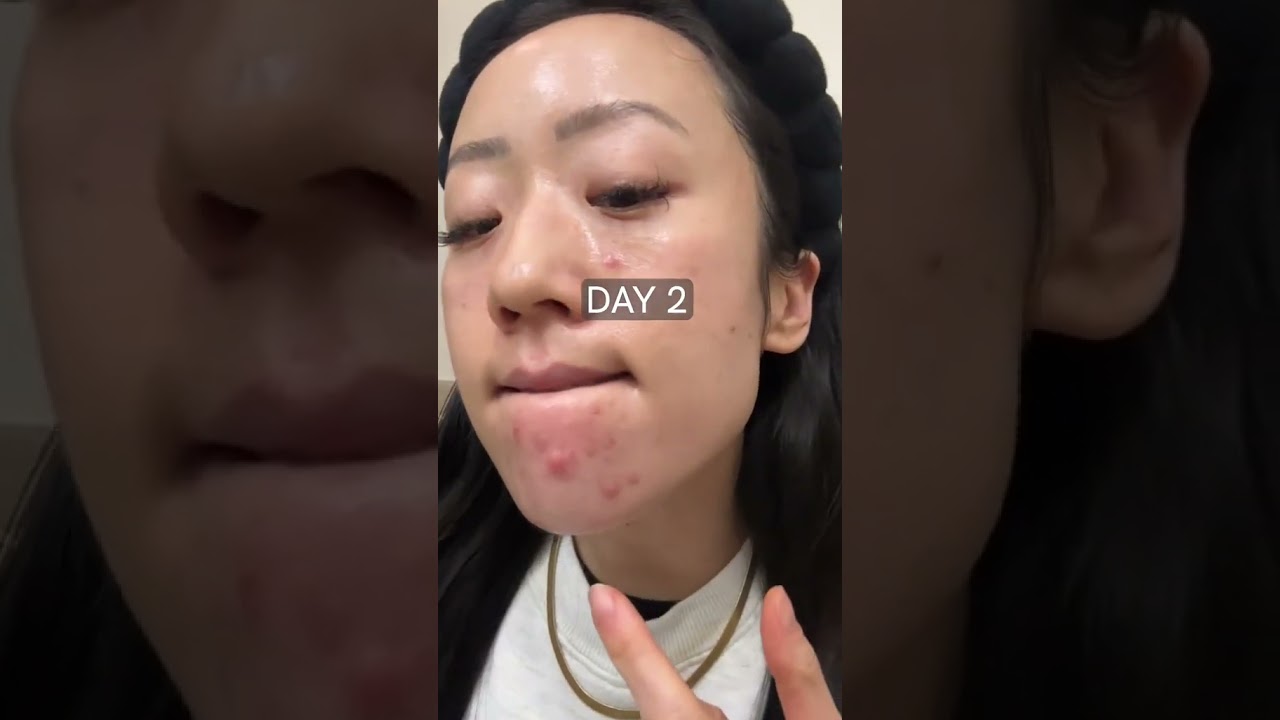 GAMECHANGING combination to getting rid of cystic acne breakouts fast!