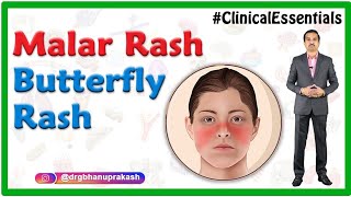 Malar rash (Butterfly rash)  Dermatology : Clinical essentials