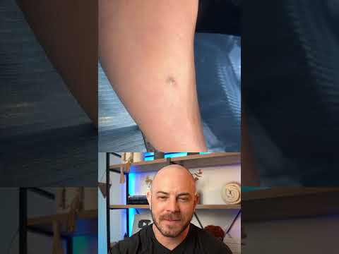 Doctor explains wild pimple popping method! #dermreacts #doctorreacts #pimplepop