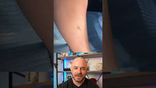 Doctor explains wild pimple popping method! #dermreacts #doctorreacts #pimplepop