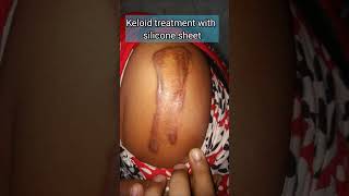 keloid treatment with silicone sheet
