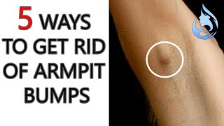 5 WAYS TO GET RID OF ARMPIT BUMPS