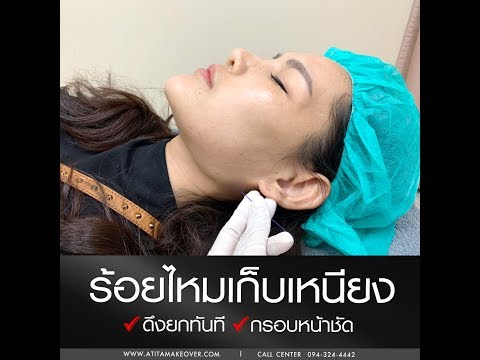 ร้อยไหม หน้าเรียว