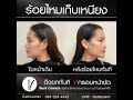 ร้อยไหม หน้าเรียว