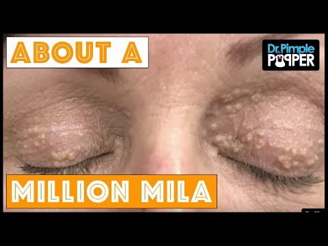Pimple Popper Eyelid Video