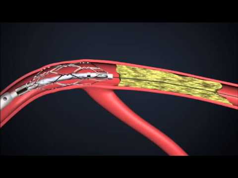 CenterCross - Roxwood Medical's newest platform