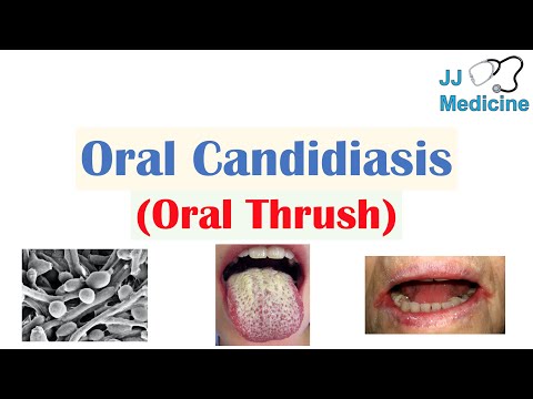 Oral Candidiasis (Oral Thrush) | Causes, Pathophysiology, Signs & Symptoms, Diagnosis, Treatment