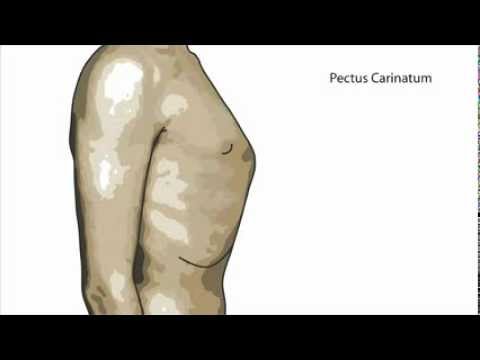 What is Pectus Carinatum?