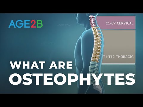 What Are Osteophytes? | Spinal Bone Spurs | Anatomy | Degenerative Disc Disease