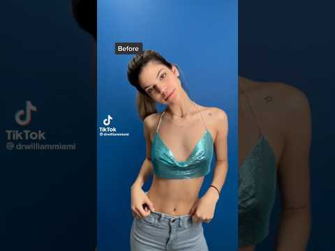 Before and After Breast Aug 😍