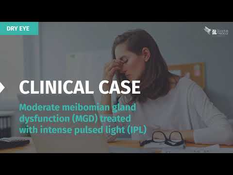 Clinical case - Moderate Meibomian Gland Dysfunction treated with Intense Pulsed Light (IPL)