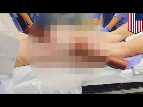 Jak zwiększyć cenę penisa chirurgicznie Zwiększenie męskiego członka